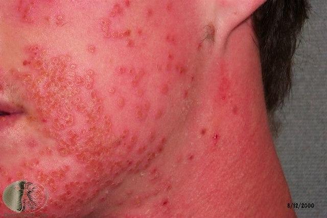 Eczema herpeticum