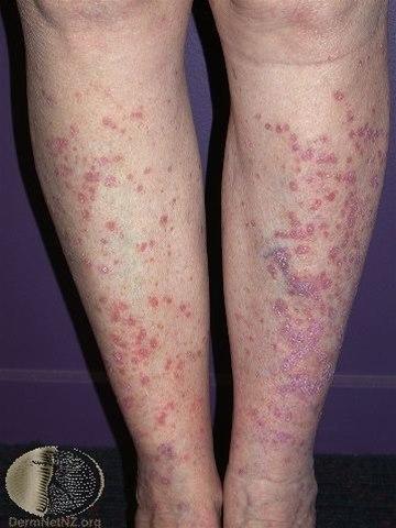 Fotoet viser lichen planus, legg