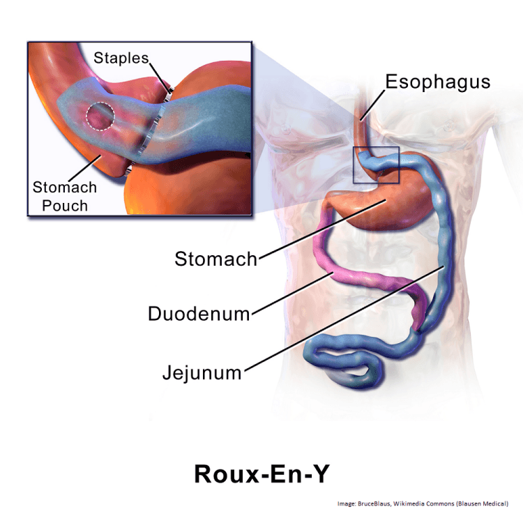 Roux-En-Y.png
