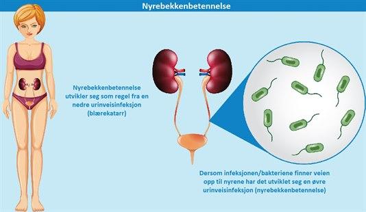 Pyelonephritis