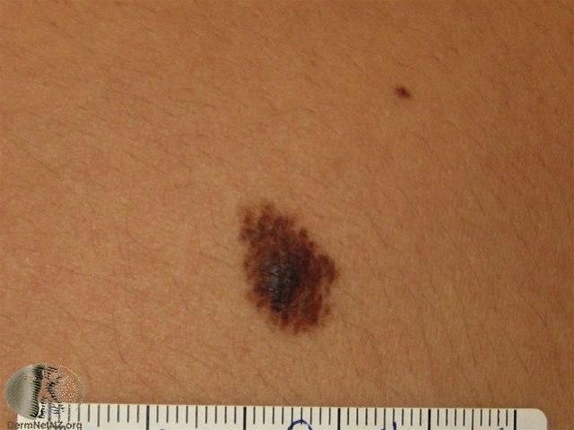 Fotoet viser nevus, irregulær