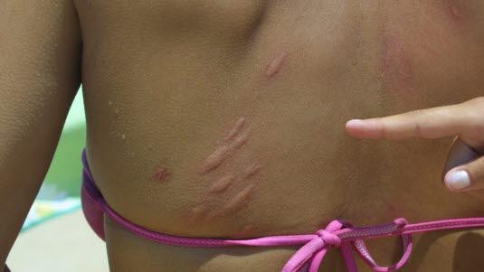 Urticaria