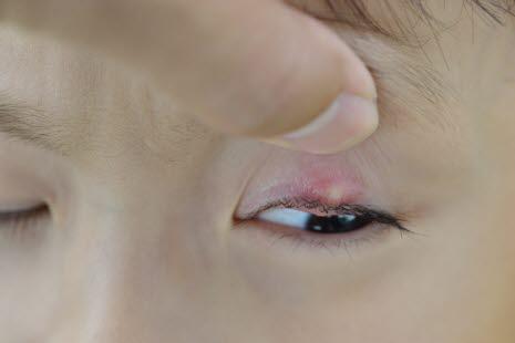 Stye (hordeolum)