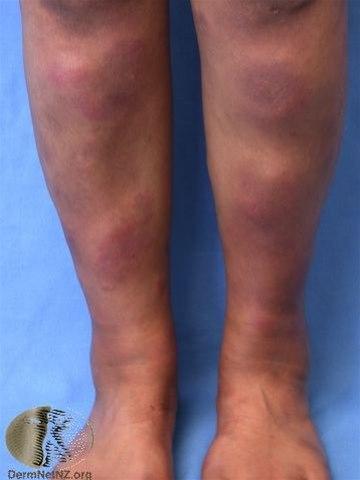 Fotoet viser erythema nodosum