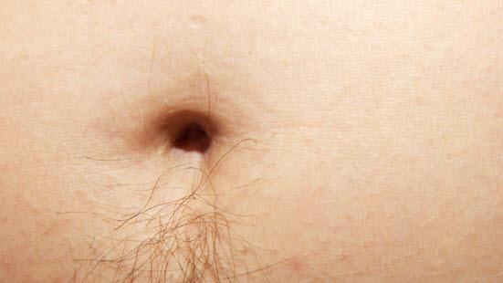 Hirsutisme