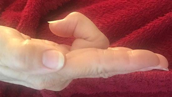 Fotoet viser triggerfinger på 3. finger av høyre hånd. Middelfingeren er låst i bøyd stilling og kan ikke strekkes ut aktivt. 