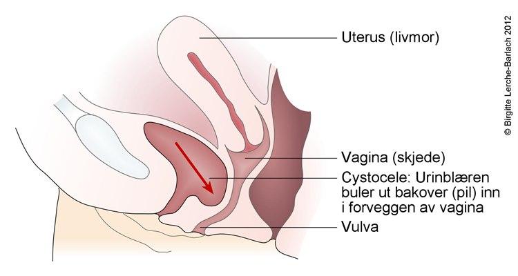 Cystocele