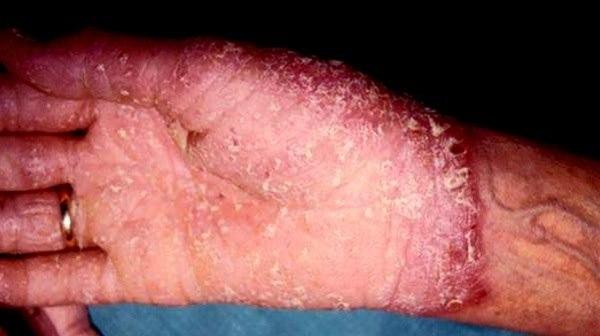 Legg merke til skarp avgrensing til normal hud. Se etter negleforandringer og psoriasisforandringer ellers på kroppen.