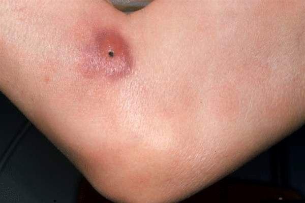 Mycosis fungoides 2