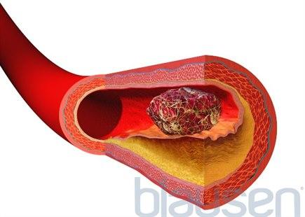 Blood clot