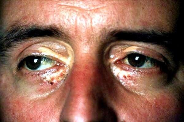 Xantelasma palpebrarum