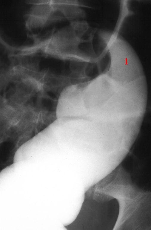 Volvulus