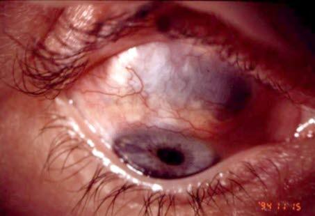 Scleritis