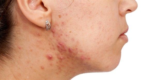 Acne