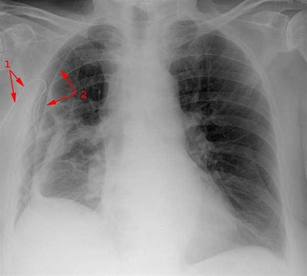 Pneumothorax med dren