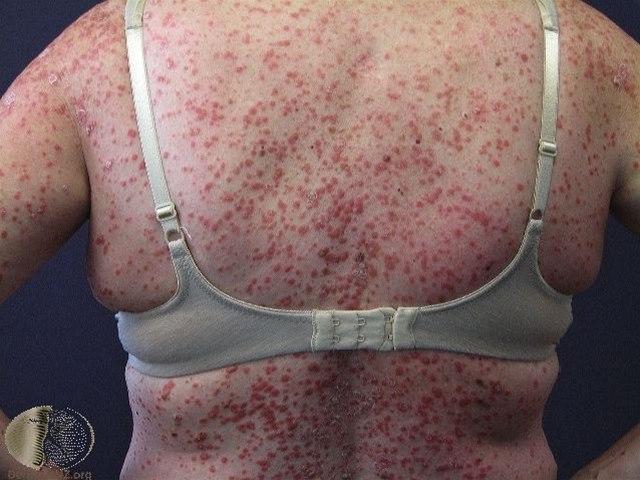 Ryggtavlen til voksen kvinne med utalte papler og plakk som følge av guttat posriasis