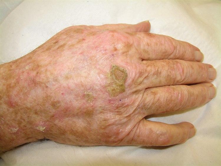 Aktinisk keratose