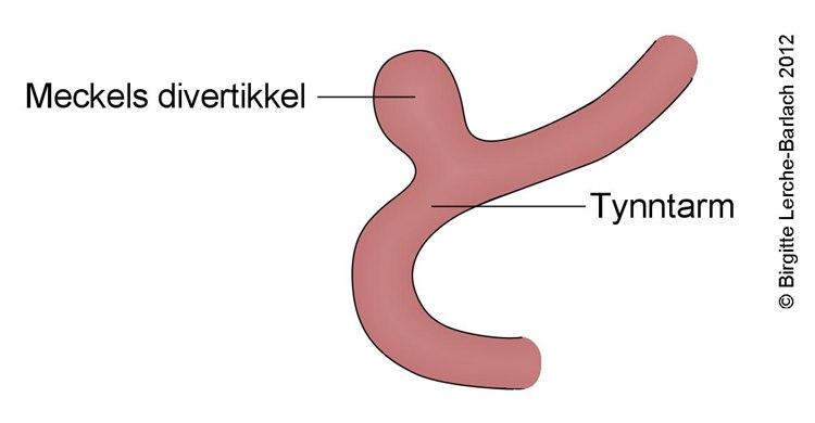 Meckels divertikkel