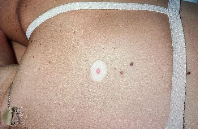 Fotoet viser nevus, halonevus
