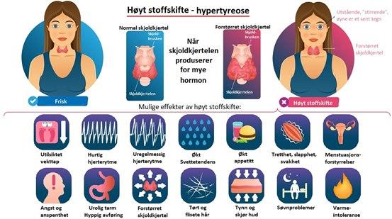 Hyperthyroidism
