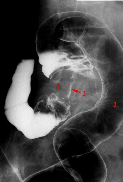 Colon cancer