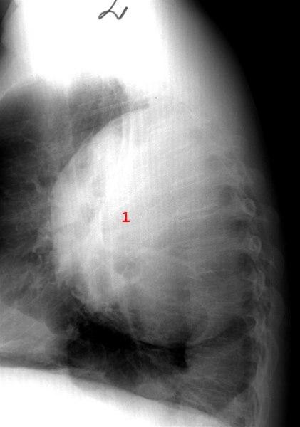Lungeabscess - side
