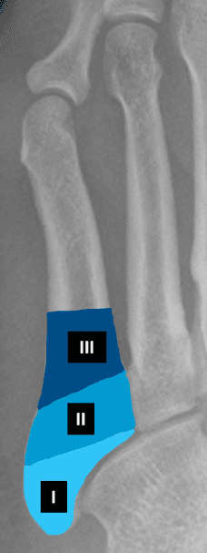 Fotoet viser et røntgenbilde med markering av de tre sonene i proksimale del av 5. metatars