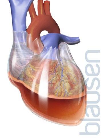 Hjertetamponade