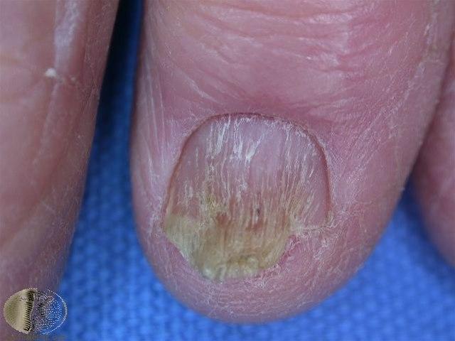Fotoet viser lichen planus, negl