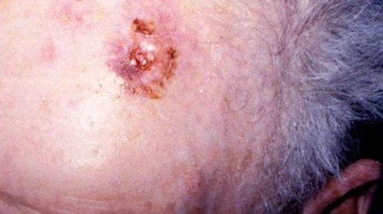 Squamous cell skin cancer, head