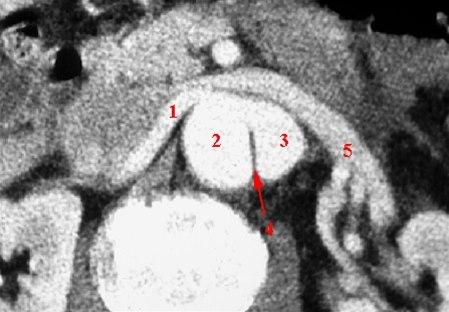 Aortadisseksjon (CT axial)