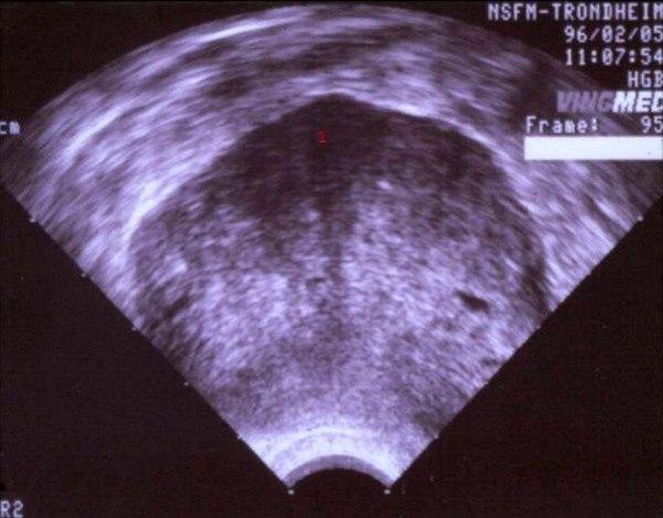 Sertoli-Leydig celle tumor