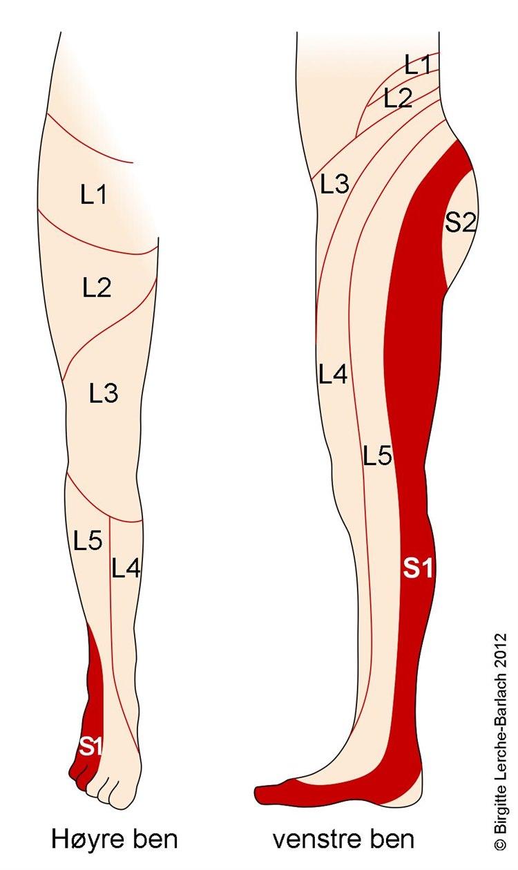 Dermatom S1