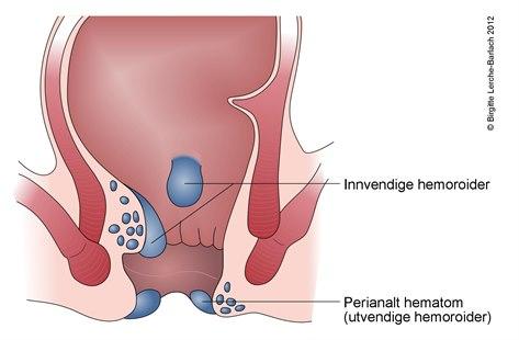 Hemoroider