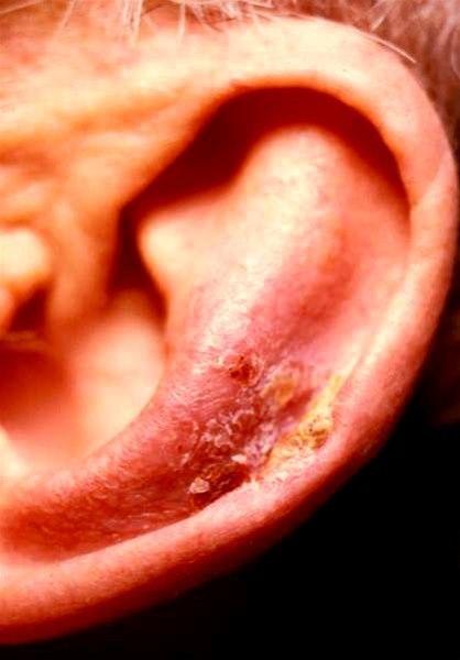 Erythematøs makel med lett skjelling og hyperkeratose. Solskade.