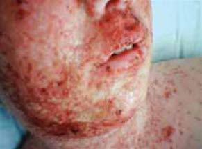 Eczema herpeticum