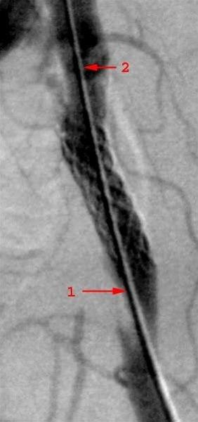 Bekkenarterie med innsatt stent