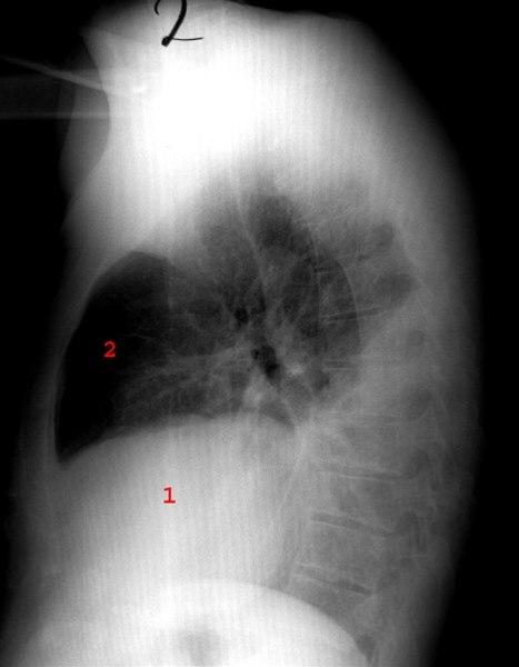 Pleuropneumoni - side