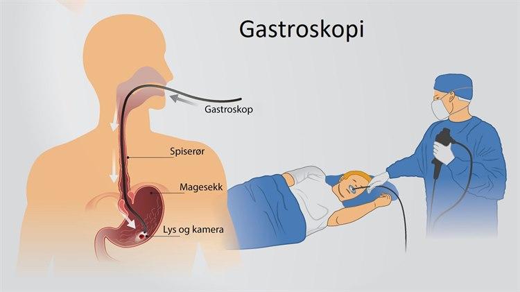 Gastroskopi