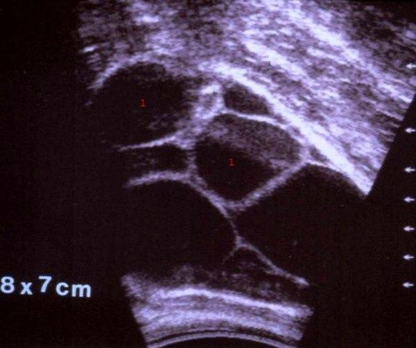 Theca-lutein cyster