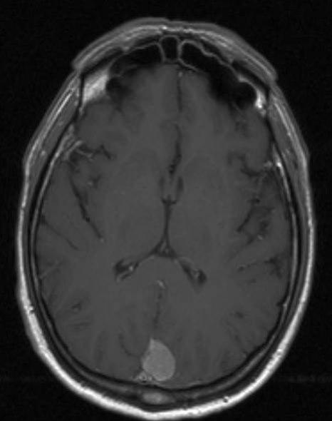 meningiom 1