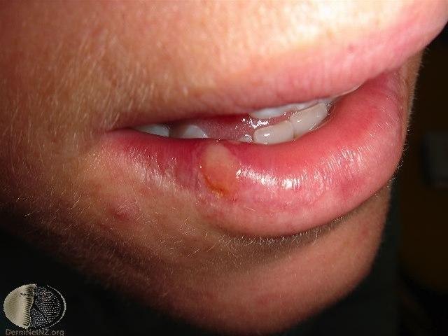 Fotoet viser herpes simplex, labialis 1