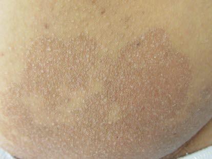 Erytrasma