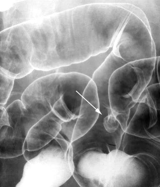 Colonpolypp