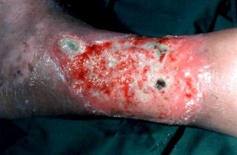 Venous ulcer