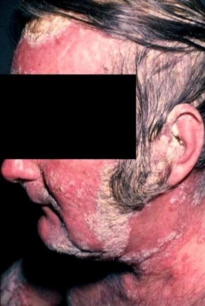 Uttalt psoriasis.