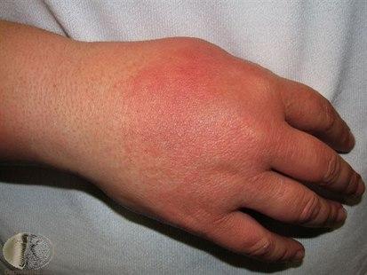 Sun burn, hand