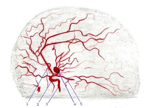 Intracerebralt aneurisme