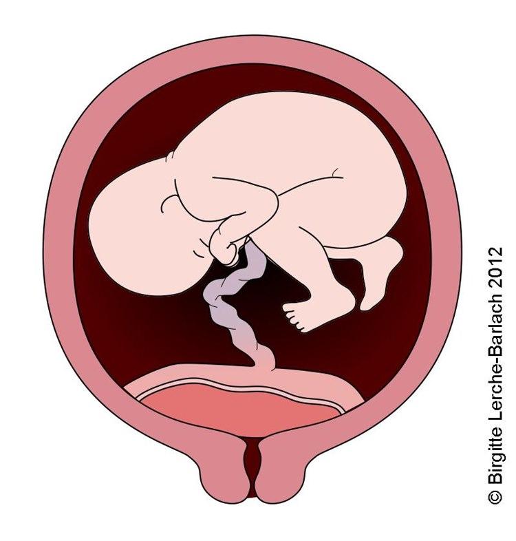 Placenta - praevia