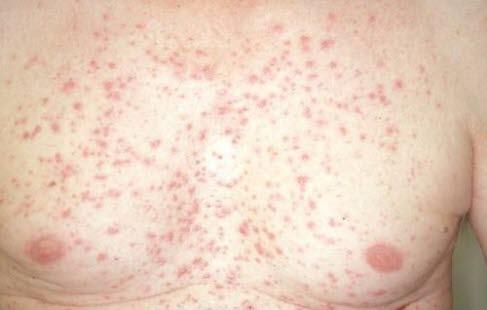 Dermatitis herpetiformis Hals